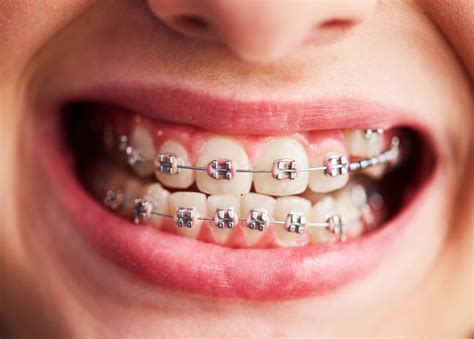 are fake braces bad for your teeth